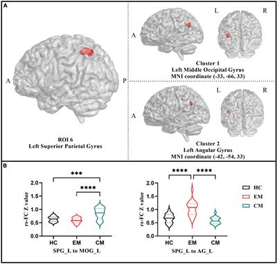 Impairments to the multisensory integration brain regions during migraine chronification: correlation with the vestibular dysfunction